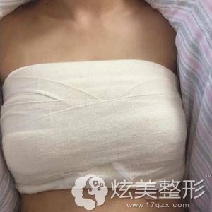 恩施华美整形刘彪医生假体丰胸术后当天 恩施华美整形刘彪医生假体丰胸术后当天