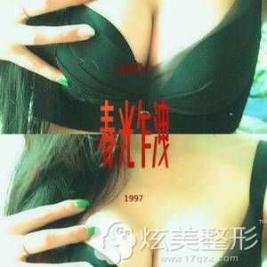 恩施华美整形刘彪医生假体丰胸20天 恩施华美整形刘彪医生假体丰胸20天