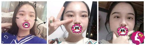 已经拆完线后的割双眼皮 已经拆完线后的割双眼皮
