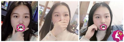 割双眼皮术后34天 割双眼皮术后34天