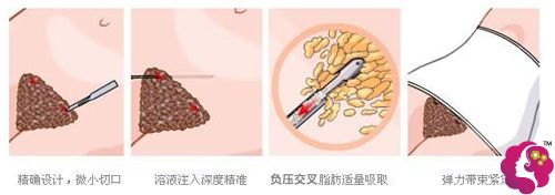 壹加壹做腹部吸脂的技术以及如何避免出现凹凸不平 壹加壹做腹部吸脂的技术以及如何避免出现凹凸不平