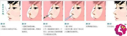 广州韩妃做鼻部整形修复的手术原理图 广州韩妃做鼻部整形修复的手术原理图