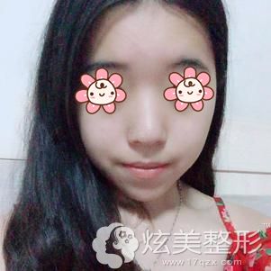 到中信惠州医院整形中心做光子嫩肤祛痘印术后20天恢复效果 到中信惠州医院整形中心做光子嫩肤祛痘印术后20天恢复效果