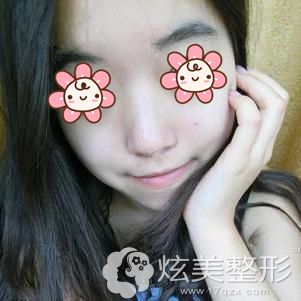 做光子嫩肤祛痘印术后10天脸部痘印大多数消失 做光子嫩肤祛痘印术后10天脸部痘印大多数消失