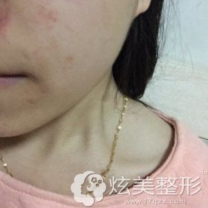 看四年痘疤到中信惠州整形中心做光子嫩肤祛痘印的效果