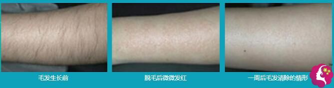 在泉州东大做冰点脱毛术后效果 在泉州东大做冰点脱毛术后效果