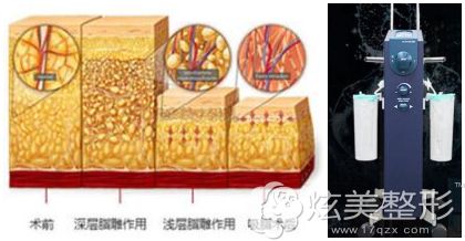 佛山曙光金子做臀部抽脂采用的技术及设备 佛山曙光金子做臀部抽脂采用的技术及设备