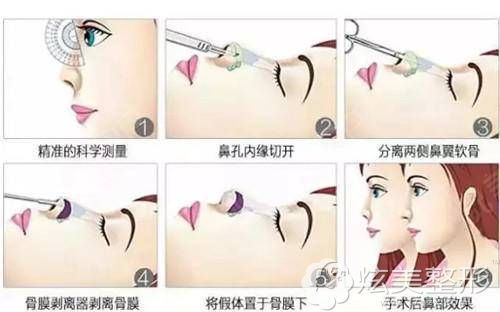 手术隆鼻过程展示 手术隆鼻过程展示