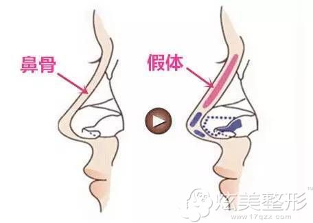 一种是膨体及硅橡胶假体 一种是膨体及硅橡胶假体