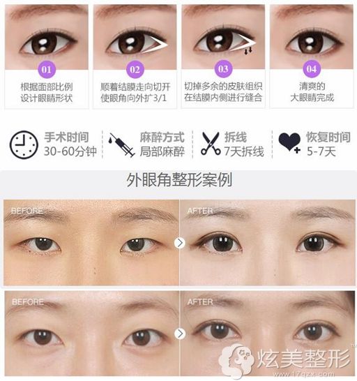 分享赣州韩美开外眼角及案例 分享赣州韩美开外眼角及案例