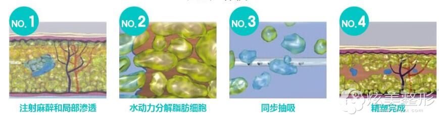 水动力吸脂瘦手臂原理 水动力吸脂瘦手臂原理