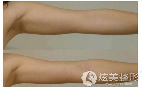 水动力吸脂瘦手臂前后对比 水动力吸脂瘦手臂前后对比