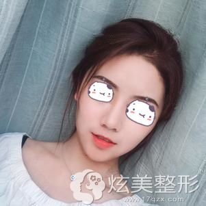 到郑州华领做耳软骨鼻综合术后59天鼻子恢复效果 到郑州华领做耳软骨鼻综合术后59天鼻子恢复效果