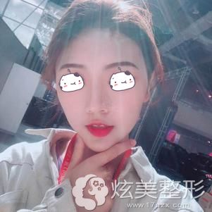 杨主任做耳软骨鼻综合手术后20天疤痕消失改善了鼻孔外露 杨主任做耳软骨鼻综合手术后20天疤痕消失改善了鼻孔外露