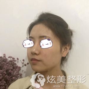 做耳软骨鼻综合术后10天鼻子肿胀渐消疤痕明显 做耳软骨鼻综合术后10天鼻子肿胀渐消疤痕明显