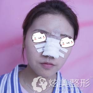 杨瑞国主任帮我做耳软骨鼻综合术后即刻 杨瑞国主任帮我做耳软骨鼻综合术后即刻