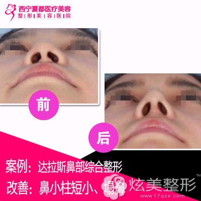 西宁夏都做鼻综合手术案例 西宁夏都做鼻综合手术案例