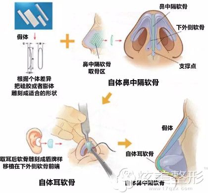 夏都整形做鼻综合手术过程 夏都整形做鼻综合手术过程