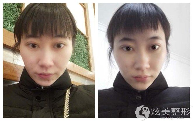 做完opt一个星期脸上斑点淡化 做完opt一个星期脸上斑点淡化