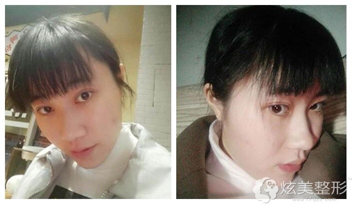 做opt去除脸上遗传性雀斑术后1个月恢复 做opt去除脸上遗传性雀斑术后1个月恢复