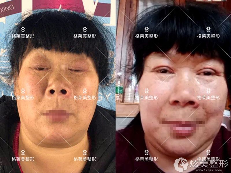 益阳格莱美眼部整形前后对比 益阳格莱美眼部整形前后对比