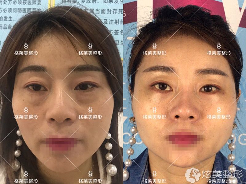 益阳格莱美眼部整形前后对比 益阳格莱美眼部整形前后对比