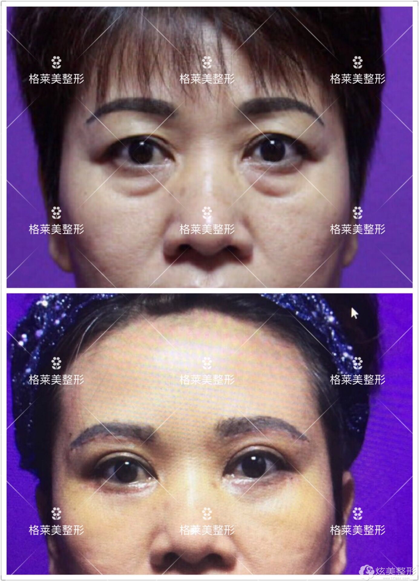 益阳格莱美眼部整形前后对比 益阳格莱美眼部整形前后对比