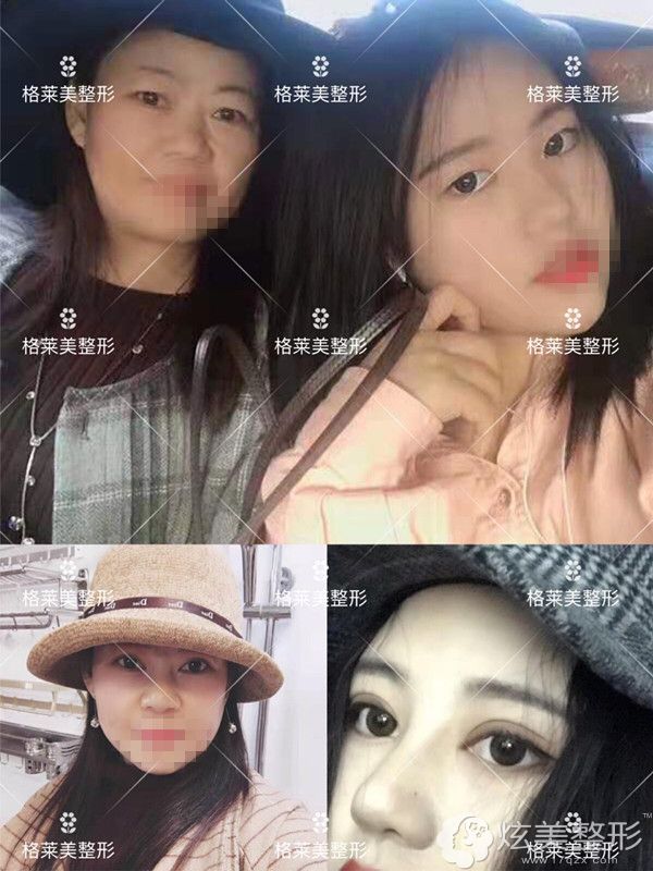 益阳格莱美眼部整形前后对比 益阳格莱美眼部整形前后对比