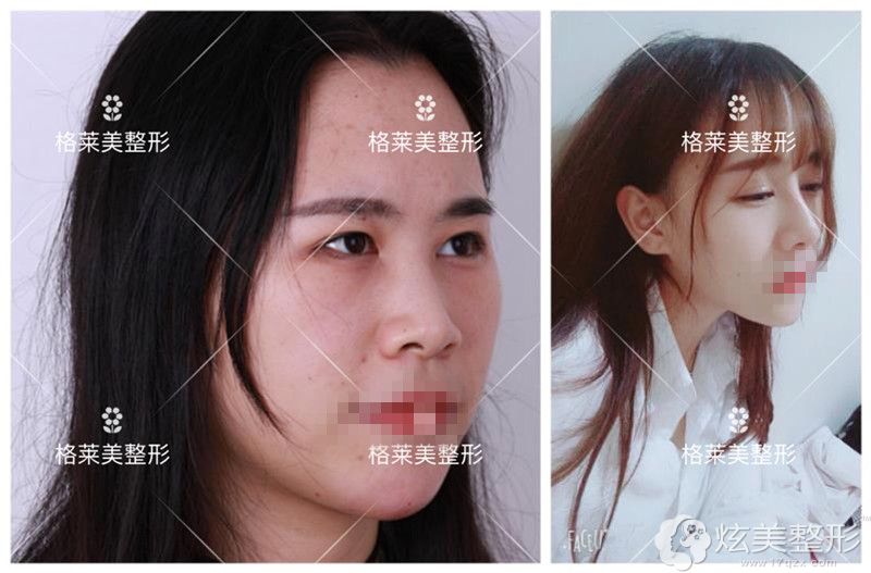 益阳格莱美鼻综合整形前后对比 益阳格莱美鼻综合整形前后对比
