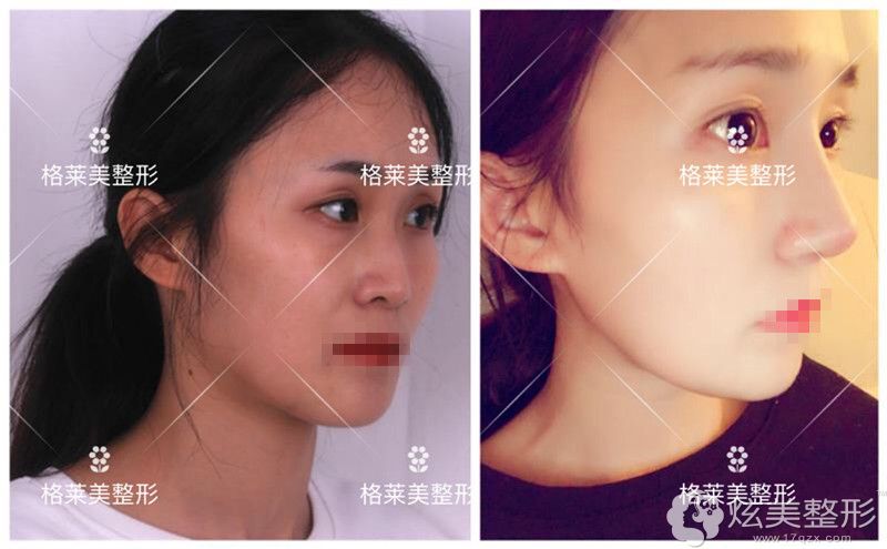 益阳格莱美鼻部整形前后对比 益阳格莱美鼻部整形前后对比