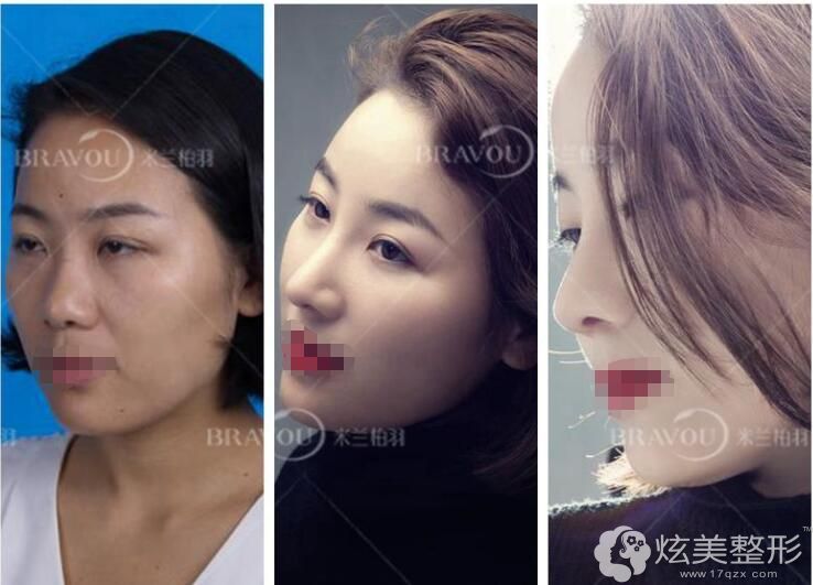 王志东医生隆鼻案例 王志东医生隆鼻案例