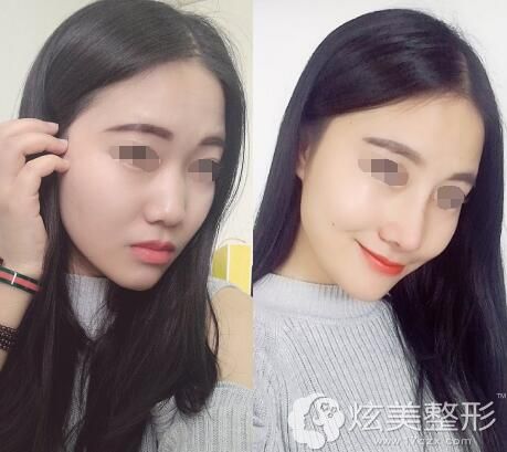 黎慧娟自体软骨隆鼻案例 黎慧娟自体软骨隆鼻案例