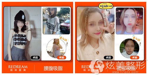 薇琳整形医院吸脂手术案例 薇琳整形医院吸脂手术案例