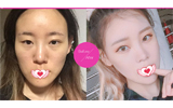 �ذ��첻��˫������ �Һ���Hb����ѫ���沿�������ξ�OK