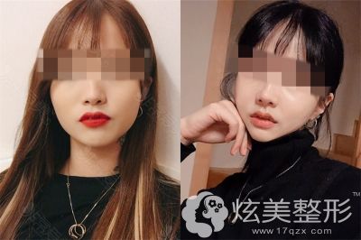 申熙震面部轮廓整形案例 申熙震面部轮廓整形案例