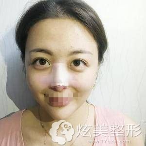 广州画美牟北平鼻综合手术后2天 广州画美牟北平鼻综合手术后2天