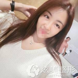 广州画美牟北平鼻综合手术后15天 广州画美牟北平鼻综合手术后15天