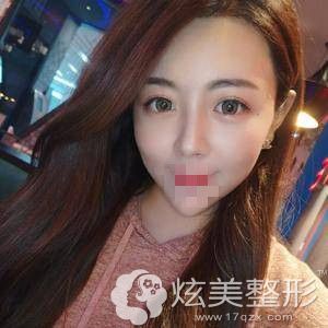 广州画美牟北平鼻综合手术后25天 广州画美牟北平鼻综合手术后25天