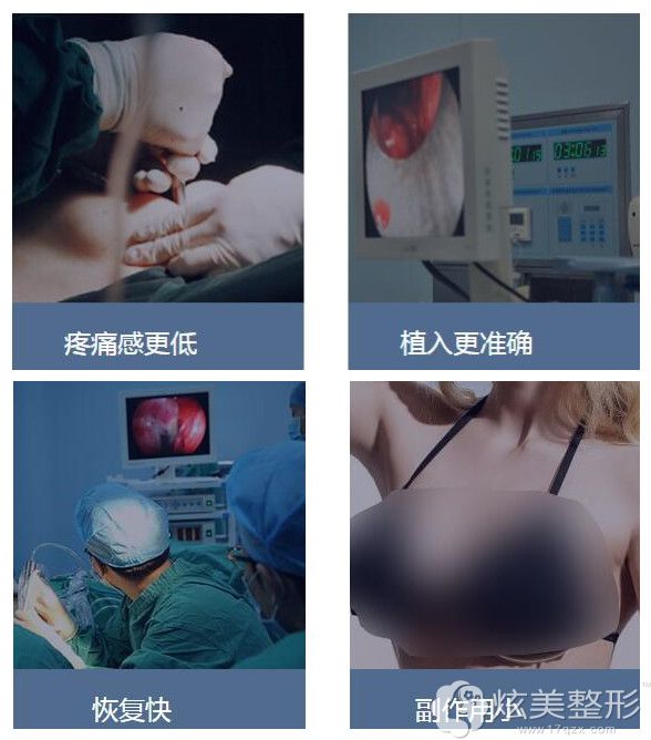 东莞内窥镜隆胸四大优势 东莞内窥镜隆胸四大优势