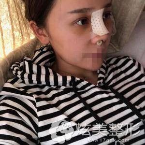 南京连天美做鼻综合手术术当天 南京连天美做鼻综合手术术当天