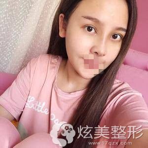 南京连天美做鼻综合手术拆线 南京连天美做鼻综合手术拆线