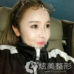 南京连天美做鼻综合手术两个月 南京连天美做鼻综合手术两个月