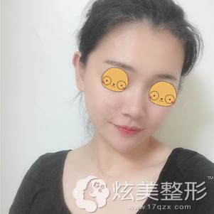 在锦州斯美诺做膨体隆鼻术后90天鼻子恢复正常效果 在锦州斯美诺做膨体隆鼻术后90天鼻子恢复正常效果