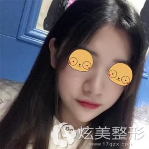 耿主任帮我做膨体隆鼻术后40天鼻子可以轻轻揉捏 耿主任帮我做膨体隆鼻术后40天鼻子可以轻轻揉捏