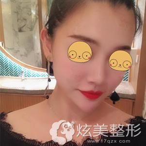 做膨体隆鼻术后20天鼻子肿胀基本消除 做膨体隆鼻术后20天鼻子肿胀基本消除