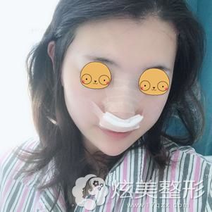 耿成虎主任帮我做膨体隆鼻术后即刻 耿成虎主任帮我做膨体隆鼻术后即刻