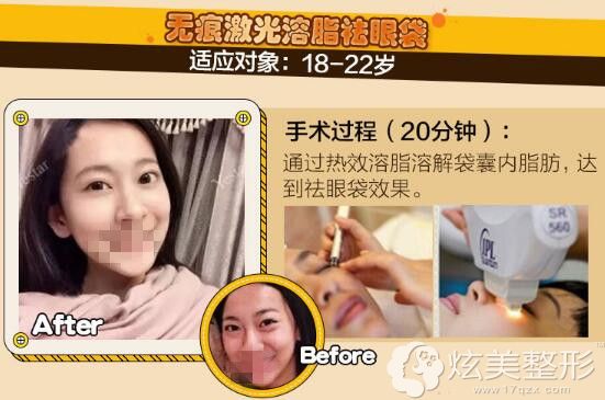 无痕激光溶脂祛眼袋 无痕激光溶脂祛眼袋