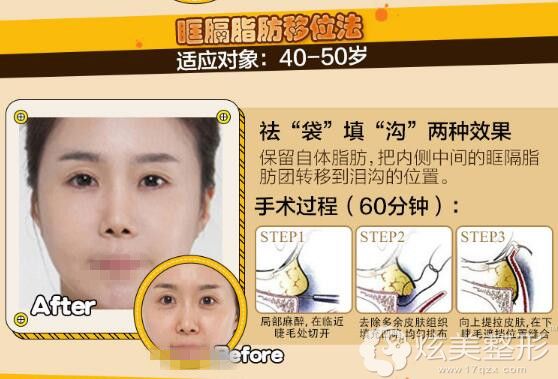 眶隔脂肪移位法 眶隔脂肪移位法