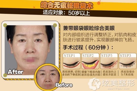 综合无痕祛眼袋术 综合无痕祛眼袋术