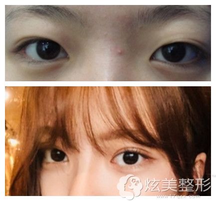郑美善院长做双眼皮手术案例 郑美善院长做双眼皮手术案例